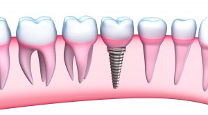 implantes dentales Madrids